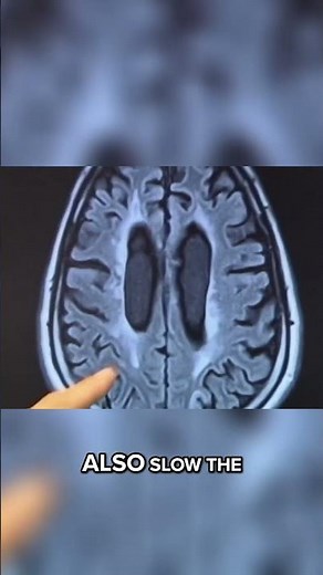 Shingles vaccine may slow, prevent dementia progression, study finds