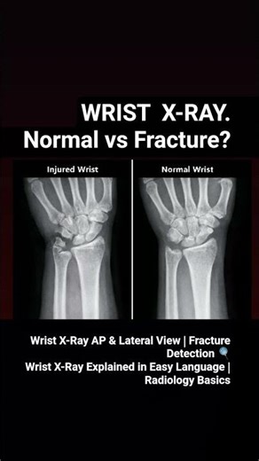 Wrist X-Ray AP & Lateral View | Fracture Detection #wristxray#xrayview#radiology#medicalstudent