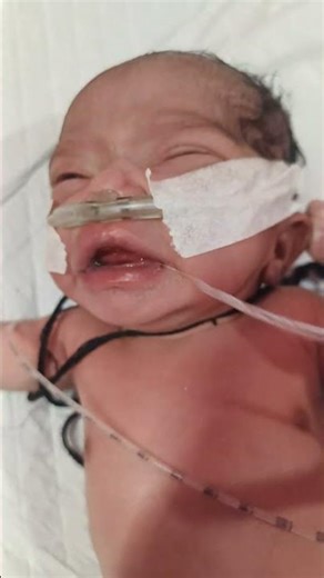 NG Tube Removal Process | Baby Having Seizure Reaction in NICU