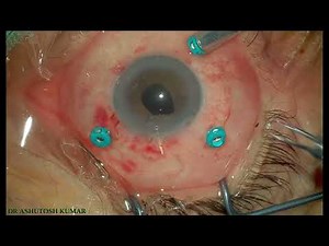 "Mastering Complex IOL Surgery: Dislocated IOL Removal & Scleral-Fixated CM-T Flex IOL Step-by-Step"