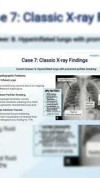 Spot Transient Tachypnea on X-Ray | Newborn Chest Radiology MCQ | Pediatric Case Review