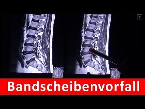 Bandscheibenvorfall in MRT Aufnahme by RadiologieTV