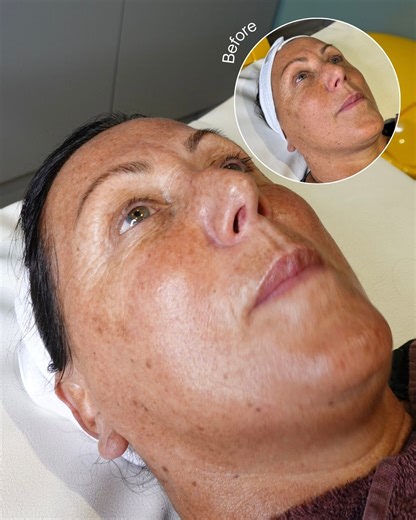 Real skin. Real results. No filters, no tricks. We’ve been testing a brand-new skin treatment behind the scenes at SV, and the before & after speaks for itself. ✨ Designed to improve skin texture, hydration, glow and overall skin health — with results that continue beyond your appointment. If you love visible results, advanced skin technology and treatments that actually work… this one’s for you. Launching soon🤍 #SkinResults #BeforeAndAfter #SkinTransformation #NewTreatment #AdvancedSkincare | 