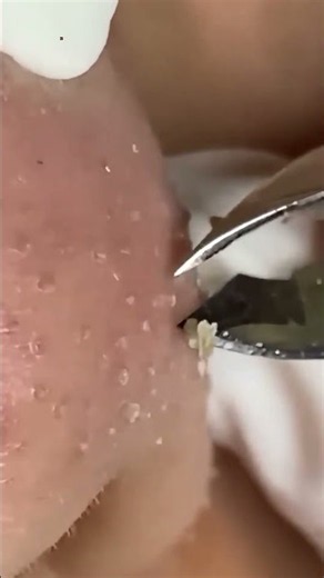 Deep Blackhead & Acne Removal | Satisfying Spa Facial Cleaning 2026 #002
