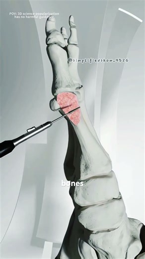 Bunion correction surgery (3D animation) #drone #theflash #space #automobile #scifi #spaceracer