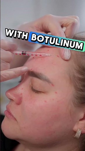 Forehead Botulinum Toxin Injection Explained #aestheticmedicine