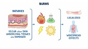 Video: Burns: Nursing pathophysiology - Video Explanation! | Osmosis | Osmosis