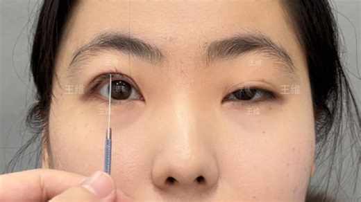 双侧重度上睑下垂 记录能睁开眼的过程