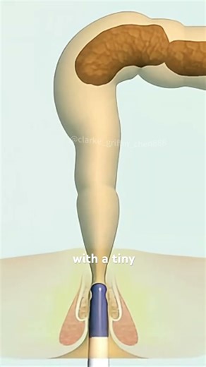 How the Peristeen System Cleans Your Bowels? (3D Animation) #peristeen #bowelcleanse #coloncleansed