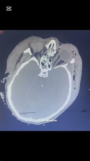 Bullet in head/ fire arm head injury