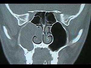 The endoscopic removal of a choanal polyp