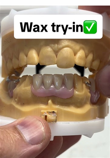 Understanding the Wax Try-In Process in Dental Prosthetics