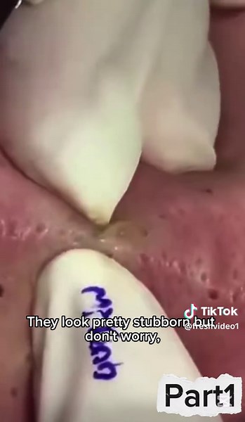 Deep Pore Cleaning | Part 1 | Satisfying Blackhead Removal Welcome to Part 1 of this deep pore cleansing session! Watch as we gently extract stubborn blackheads and clear up the skin step by step. Perfect for anyone who loves skincare, ASMR, or just a super satisfying clean-up moment. Don’t forget to follow for Part 2 — the glow-up continues! #removal #skincare #satisfaction #extraction #pimplepopping