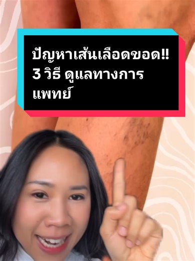 โรคเส้นเลือดขอด: สาเหตุและการดูแล
