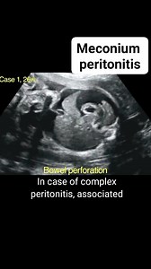 Meconium peritonitis on ultrasound #fblifestyle #radiology #radiologist #ultrasound #radiologyeducation #radiologybooks #diagnosticradiology | Radiology Interesting
