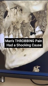 Moving pain & throbbing teeth? Don't ignore it! This case shows why a CT scan can reveal hidden problems & lead to the right treatment. #dentalhealth #dentalcare #cbctscan #throbbingpain | Living Well with Dr. Michelle Jorgensen