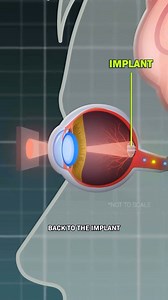 This new eye implant might save your eyesight. Especially when you get older... The patients all had cells at the back of their eye that died because of an age-related disease, but doctors implanted a tiiiiiny microchip connecting to a pair of glasses with a camera on the front It takes in images, processes them, sends it to the implant, then to the brain, giving people back their sight. For more optimistic science and tech stories, follow along! Cr • @cleoabram #science #tech #eyes #medicine #a