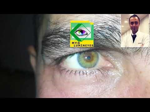 Laser Eye color change surgery Dr. Mete