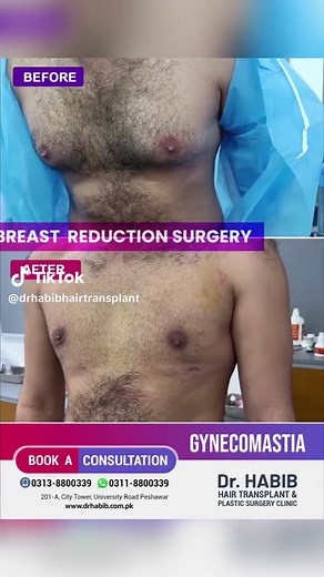 Gynecomastia | Male Breast Reduction Surgery | Dr. Habib Ullah Shah . . . . . . . . . . #drhabibhairtrasplantandplasticsurgeryclinic #gynecomastia #malebreastreductionsurgery