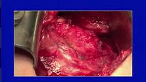 How I do an Open Bankart Repair