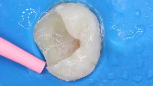 28K views · 190 reactions | Attention 醴 Dental Students! Learn the Indirect Pulp Capping procedure by Dr. Andre Reis | Aesthetic Dentistry | Facebook