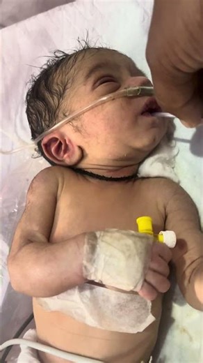 How NG Tube Is Inserted for a Newborn Baby | Newborn NG Tube Procedure
