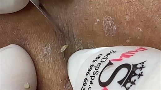 part 8 #pimple #popping #pop #satisfy