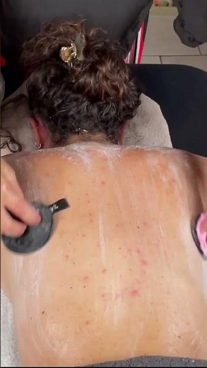 ASMR: Back ACNE Removal Treatment at Home! #shorts #asmrmassage #asmr #backmassage #acneremoval