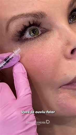 Microbotox: a técnica que suaviza sem alterar sua expressão natural Você já ouviu falar em microbotox? Ele é um dos meus favoritos para tratar aquelas ruguinhas que aparecem quando você sorri, sem pesar, sem travar o seu sorriso e sem criar aquele volume indesejado na bochecha. No vídeo, usei a Stephany como modelo (ela está grávida e não está de botox, apenas demonstrando a área). Quando ela sorri, essas pequenas ruguinhas ao redor dos olhos e na pálpebra inferior são exatamente onde o microbot