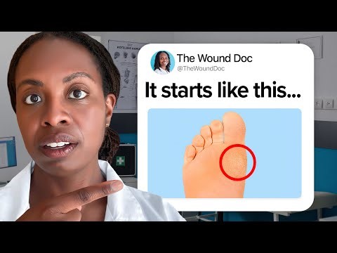 7 Signs of Diabetic Feet You Shouldn’t Ignore: Doctor Explains What to Look For Before It’s Too Late