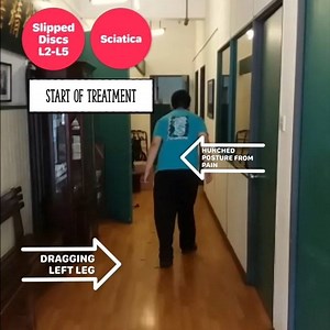 SLIPPED DISCS, also known as herniated or prolapsed discs is a common...