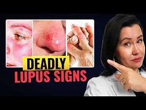 11 DEADLY Signs of Lupus You Should Never Ignore