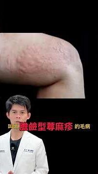 運動、跑步、身體一熱就很癢、起疹子？！｜黃千耀皮膚科醫師