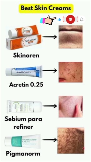 Best Skin Creams for Clear & Glowing Skin || Skinoren Acretin, Sebium Pigmanorm Review