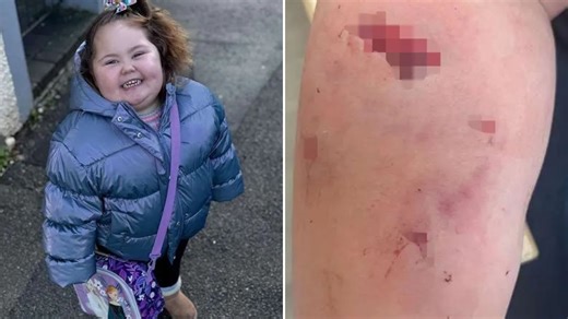 Toddler, 3, horrifically mauled by cockapoo as dad 'held her arm together'