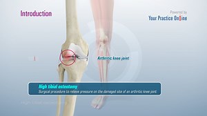 High Tibial Osteotomy