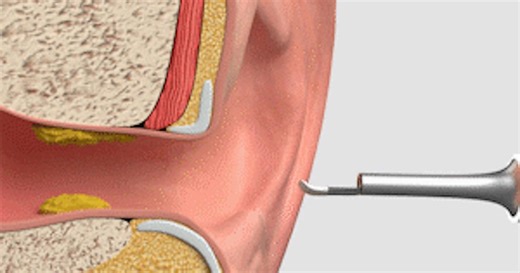 Give yourself an eargasm with Bebird's visual ear-cleaning rod