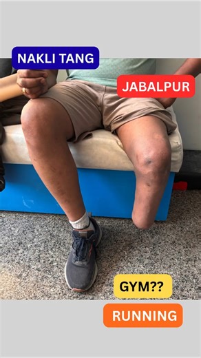 Below knee Artificial Leg Price | Liner lock System | Nakli Tang Cost #ossur #ampute #motivation