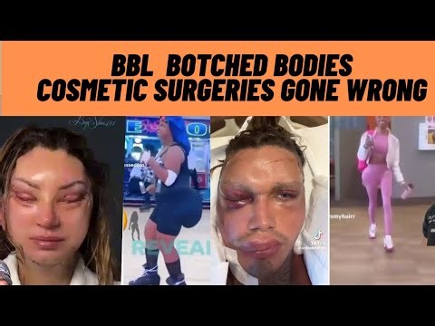 BBL MISTAKES | COSMETIC SURGERY TRAUMAS, | BOTCHED BODIES | COSMETIC SURGERIES GONE WRONG