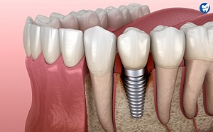 Dental Implant Problems | Potential Complications, Implant Care, FAQs