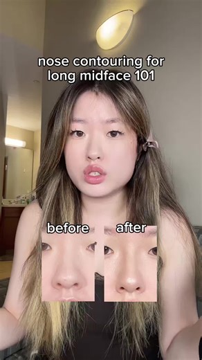 Mastering Midface Contouring Techniques