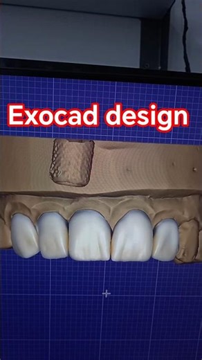 exocad bridge design