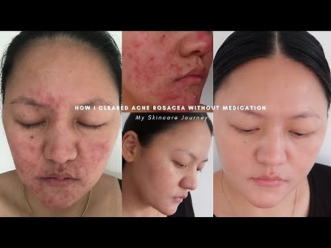 How I cleared acne rosacea without medication | Skincare storytime & simple routine