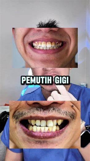 Effective Tips for Teeth Whitening with Gigi Toothpaste