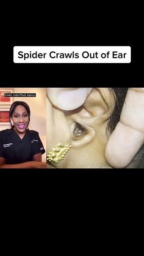 Spider Crawls Out of Ear Video