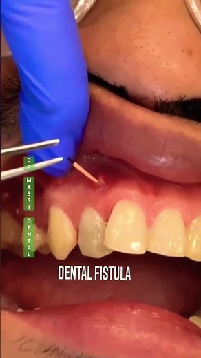 DENTAL FISTULA, gutta percha trick