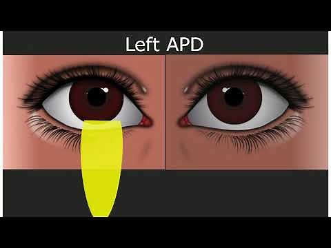 Relative Afferent Pupillary Defect - Medical Student Education