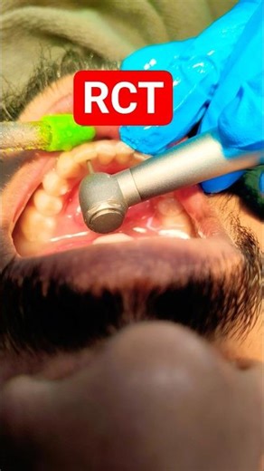 #RCT #Root Canal Treatment #Access Opening in lower Lateral Incisor Left side #dental treatment