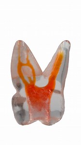 TrueTooth – Molar - PlanB Dental