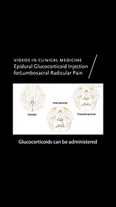 9.1K views · 68 reactions | A new video discusses indications, reviews relevant anatomy, and demonstrates techniques for epidural glucocorticoid injection for lumbosacral radicular pain. Link to full video and accompanying article in comments. | The New England Journal of Medicine | Facebook